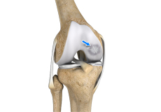 Osteochondritis Dissecans of the Knee