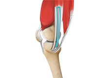 ACL Reconstruction Procedure of Hamstring Tendon