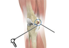 Arthroscopic Reconstruction of the Knee for Ligament Injuries