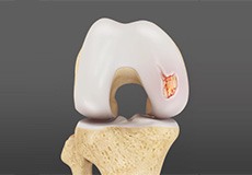 Chondral or Articular Cartilage Defects