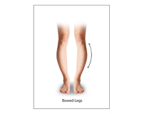 Bowed Legs