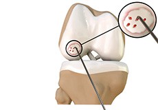 Chondroplasty