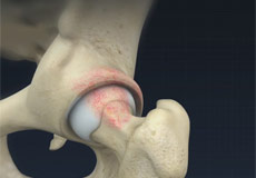 Femoroacetabular Osteoplasty