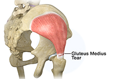 Gluteus Medius Tear