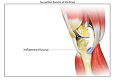 Goosefoot Bursitis of the Knee