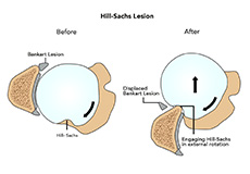 Hill-Sachs Lesion