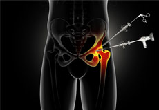 Hip Arthroscopy - Supine Position