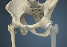 Hip Fracture Surgery