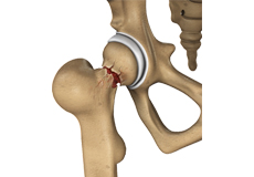 Hip Injury