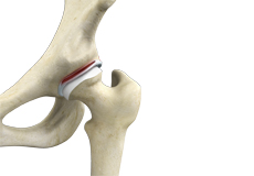 Hip Labral Tear