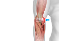 Hyperextension Injury of the Elbow