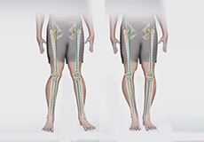 Knee Angular Deformities