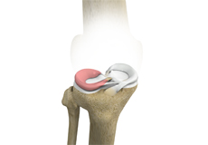 Lateral Meniscus Syndrome