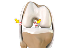 Multiligament Instability