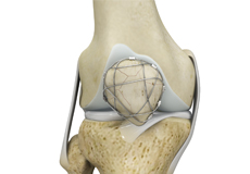 ORIF of the Knee Fracture