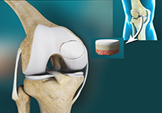 Osteochondral Defect of the Knee