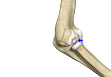 Osteochondritis Dissecans of Elbow