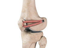 Patellofemoral Knee Replacement