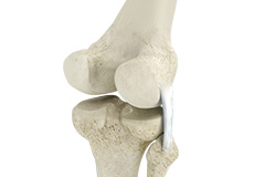 Posterolateral Corner Reconstruction