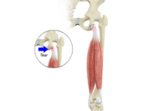 Proximal Hamstring Repair