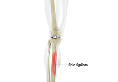 Shin Splints