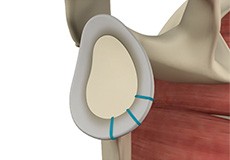 Shoulder Labrum Reconstruction